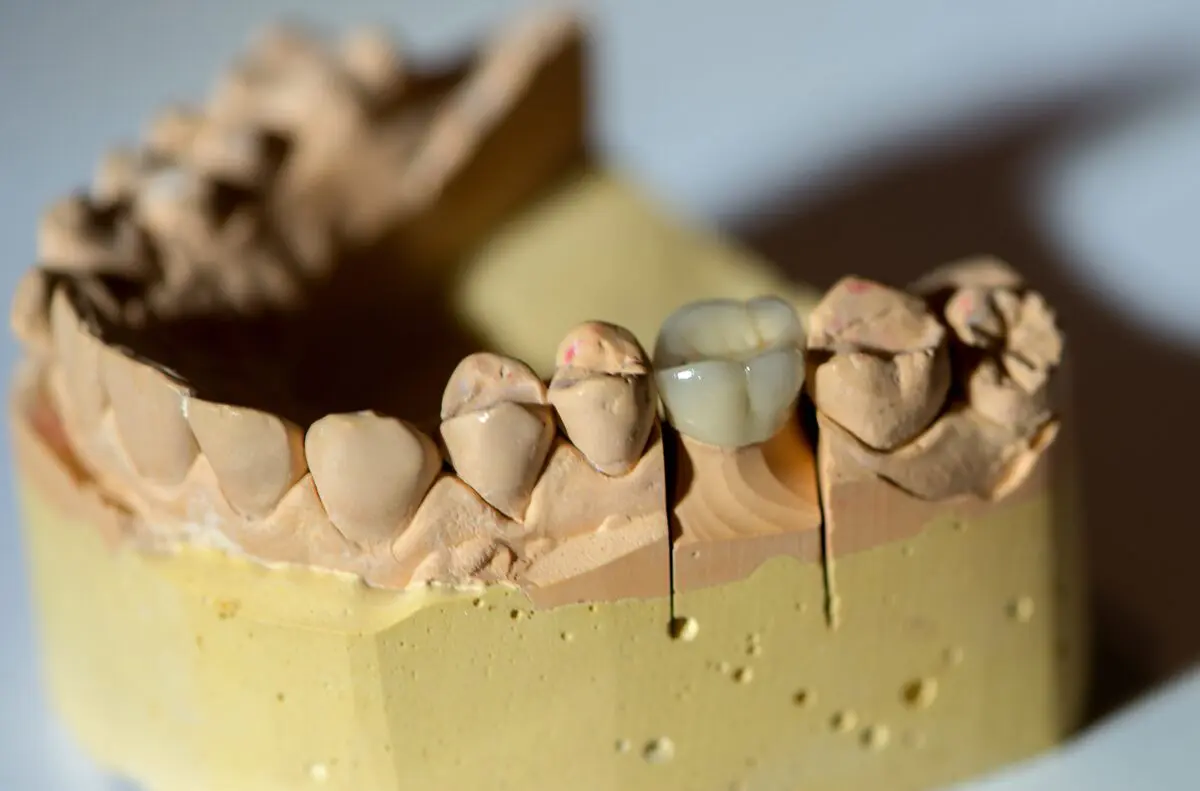 CEREC Dental Crown in Kelowna Dental office