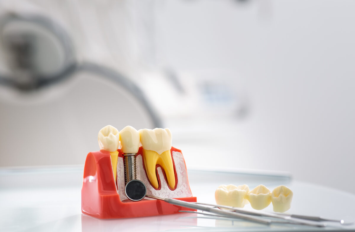 Kelowna dental clinic crown options